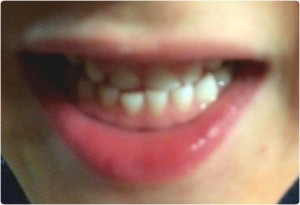 tandenwissel